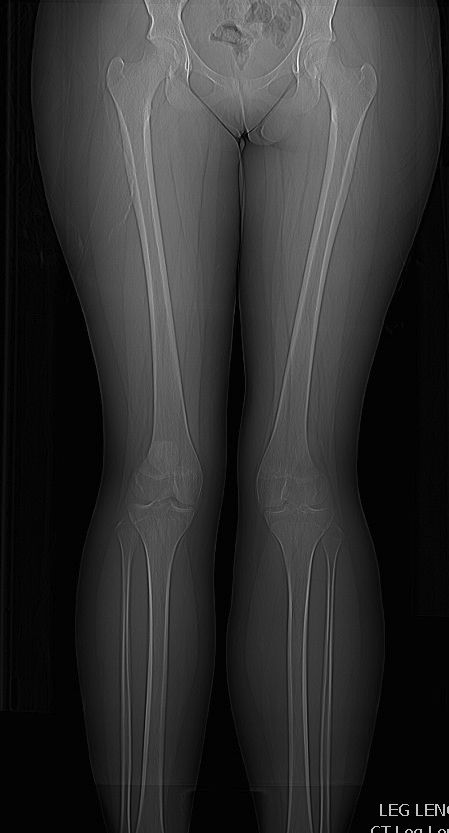 Patella Instability Long Leg Views Valgus Malalignment